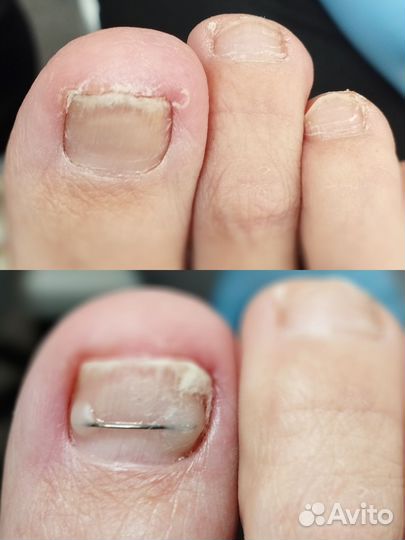 Установка титановой нити