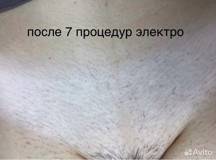 Депиляция Шугаринг Воск Электроэпиляция