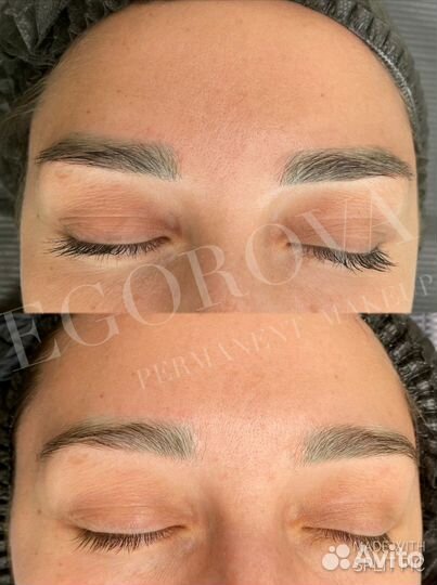 Удаление татуажа ремувером