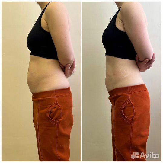 Липосоникс liposonix