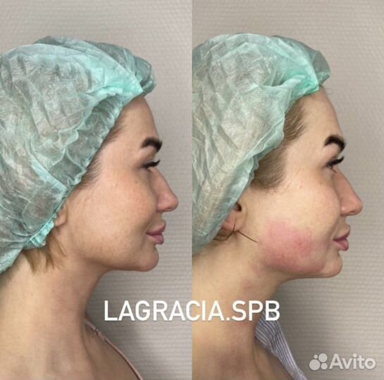 Модель SMAS lifting