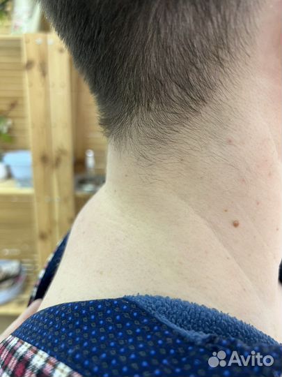 Липосакция аппаратная