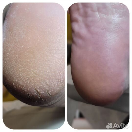 Маникюр. Препаратно Аппаратный Педикюр