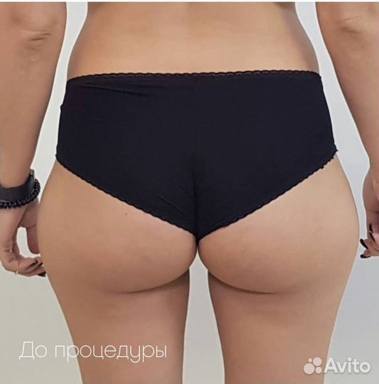 Криолиполиз. Безоперационная липосакция