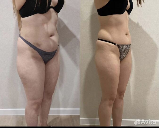 Аппаратный антицеллюлитный массаж