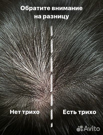 Трихопигментация головы/облысение