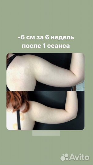 Антицеллюлитный массаж, Липопластика