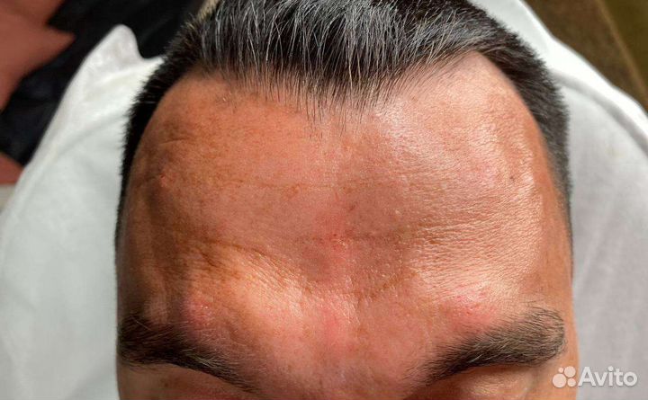 Инъекции ботокса в лоб