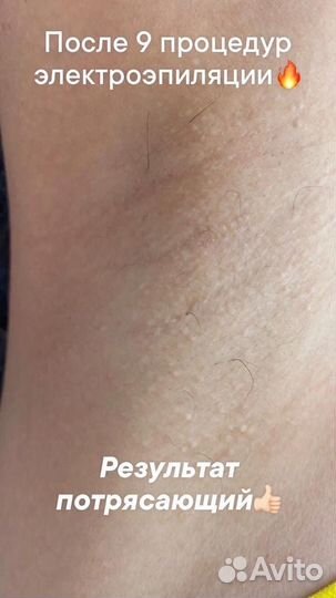 Индивидуальное обучение электроэпиляции