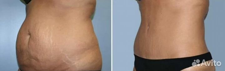 Коррекция фигуры Liposonic / Похудение без диет