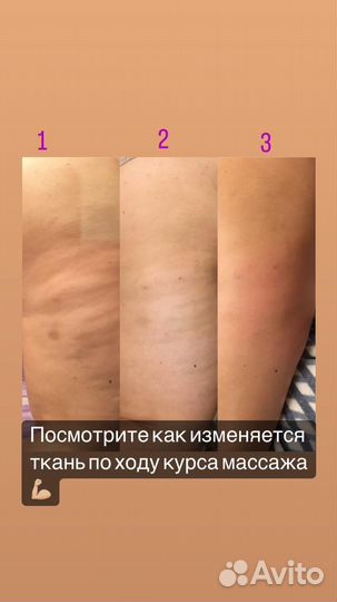 Антицеллюлитный массаж ручной