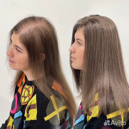 Система замещения волос при алопеции модель