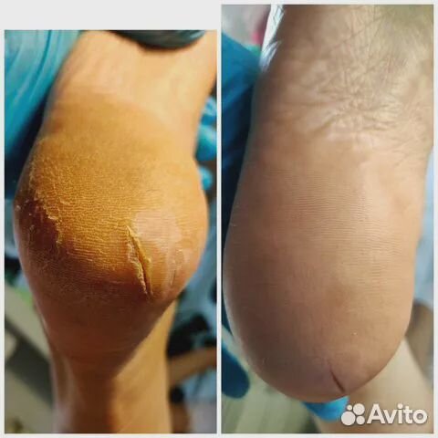 Подолог, педикюр