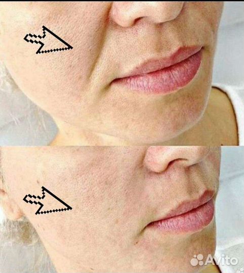 Контурная пластика