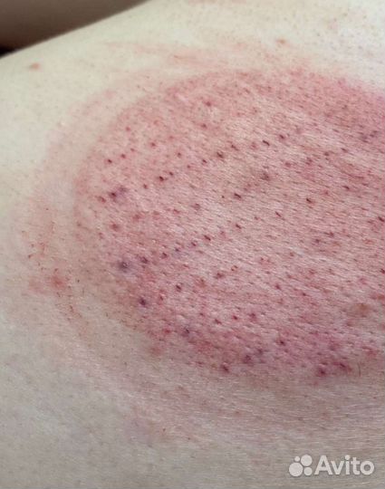 Банки для хиджамы