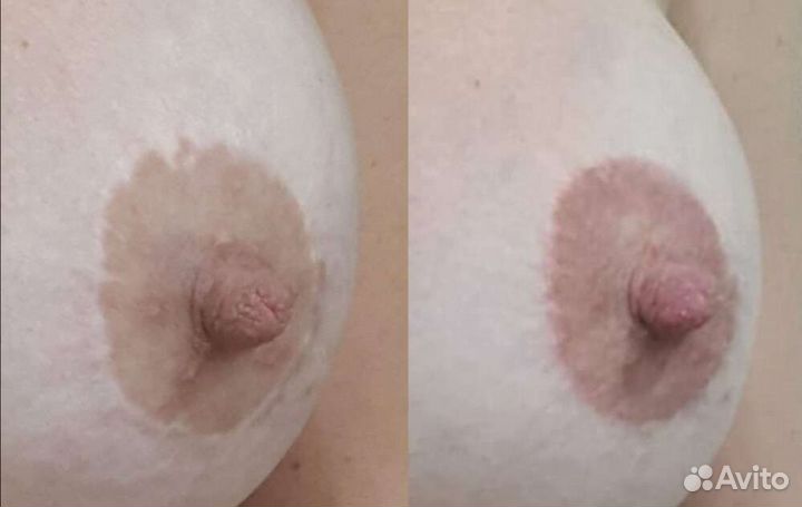 Камуфляж шрамов, ореол. Перекрытие татуажа