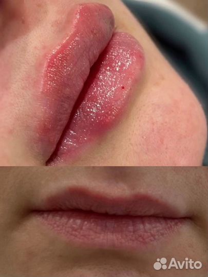 Увеличение губ