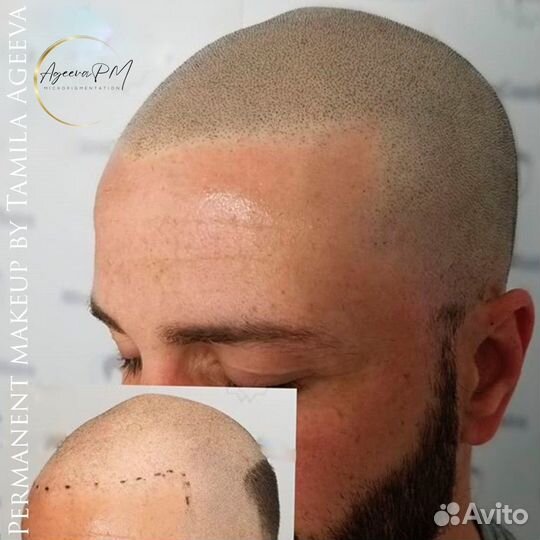 Трихопигментация, камуфляж шрамов и ожогов