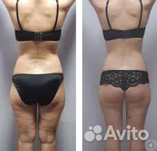 Криолиполиз, LPG, коррекция фигуры Светлогорск