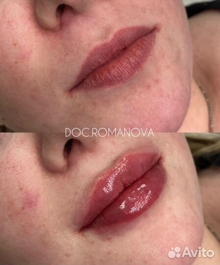 Косметолог. Увеличение губ