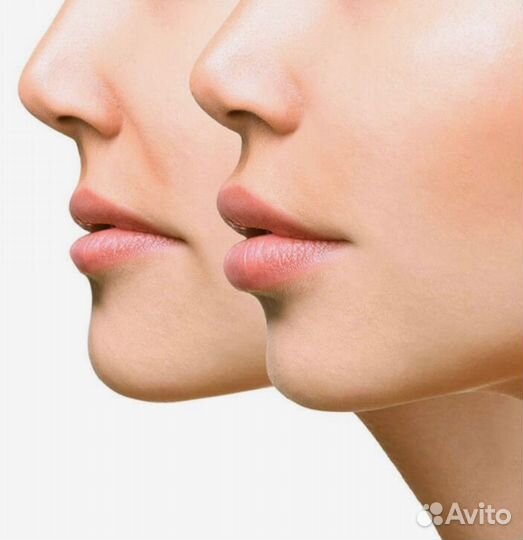 Инъекции ботокса