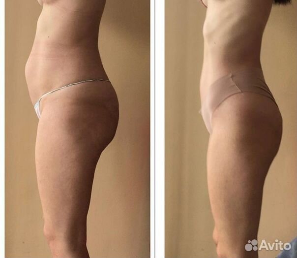 Карамельная липосакция