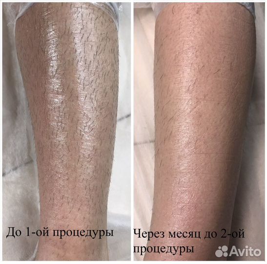 Электроэпиляция