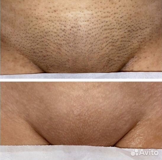 Лазерная эпиляция