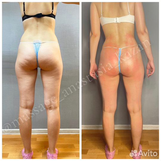 Антицеллюлитный массаж