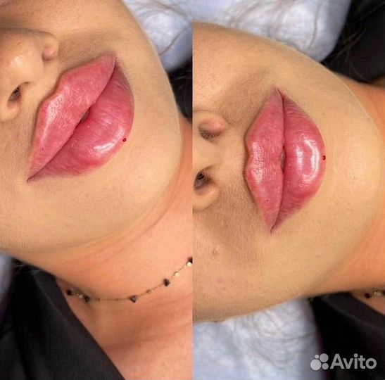 Увеличение губ Full Face Липолитик Углы