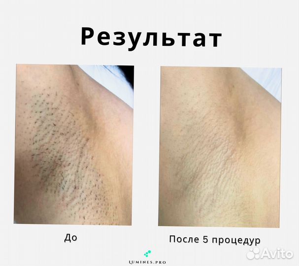 Аппарат для эпиляции Люминес. Max One 1200 Вт