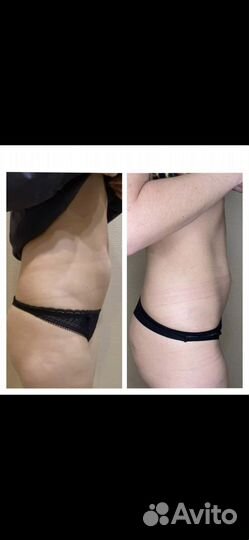 Криолиполиз