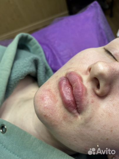 Модель на увеличение губ