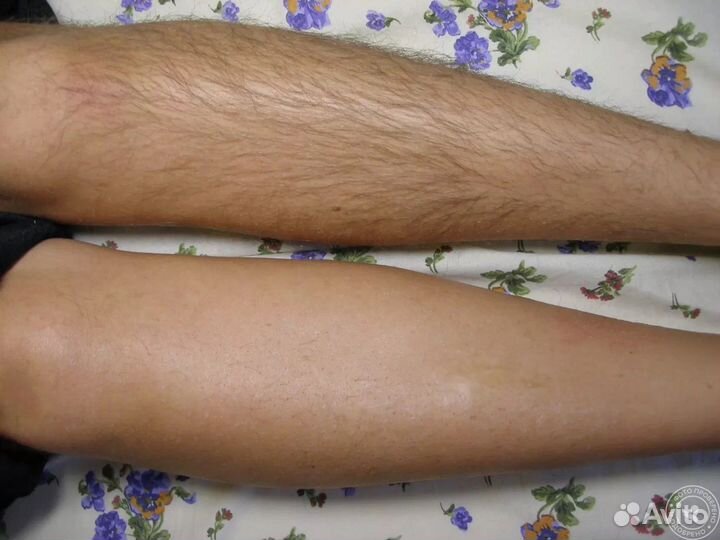 Электроэпиляция