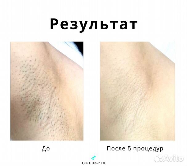 Диодный лазер для эпиляции Люминес Max One 1200 Вт