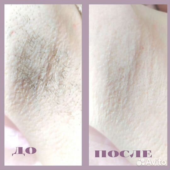Шугаринг в Кудрово