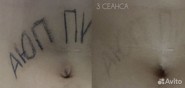 Лазерное удаление тату и татуажа