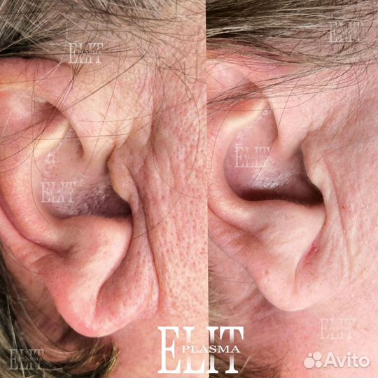 Омоложение холодной плазмой Ангарск