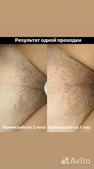 Электроэпиляция