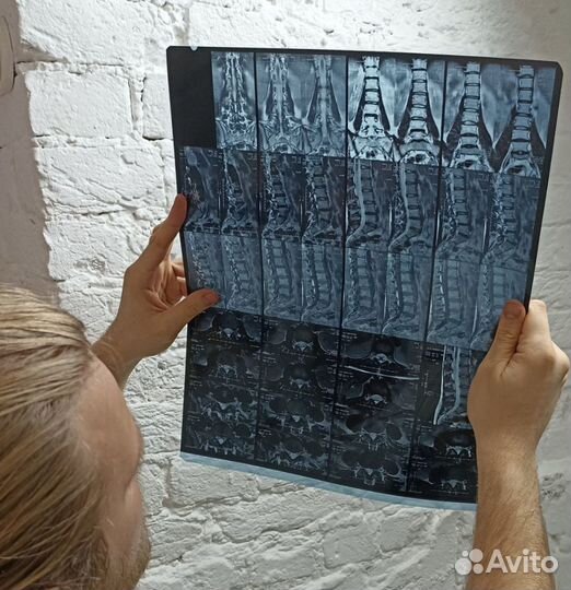 Миофасциальный массаж. Триггерные точки. Мфс