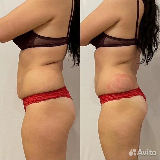 Криолиполиз, безоперационная коррекция фигуры