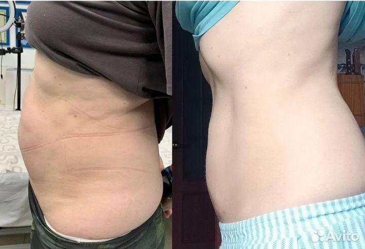Липосакция без операции