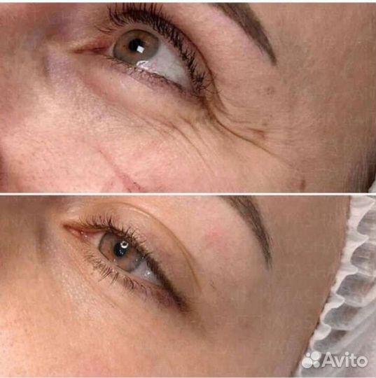 Нужны модели на процедуру Botox