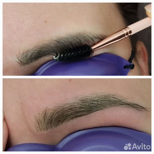 Лазерное удаление тату