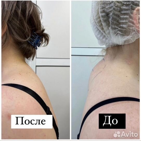 Безоперационно убираю – «вдовий горбик», «холку»