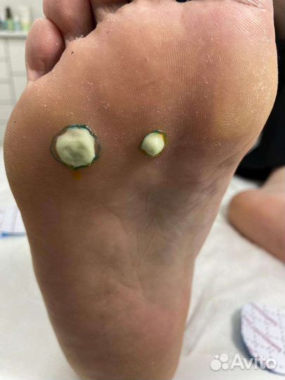 Медицинский педикюр/Подолог