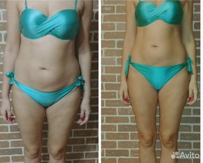 Карамельная липосакция