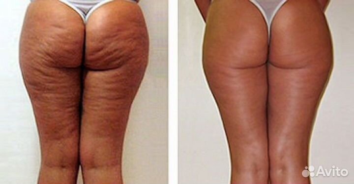 Антицеллюлитный крем