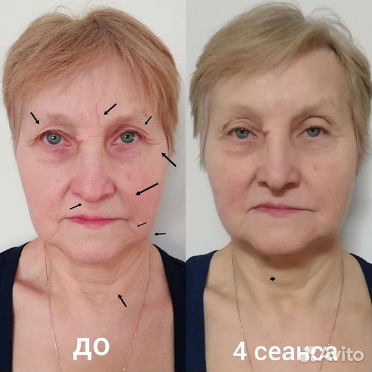 Витапластика