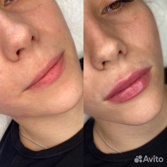 Увеличение губ